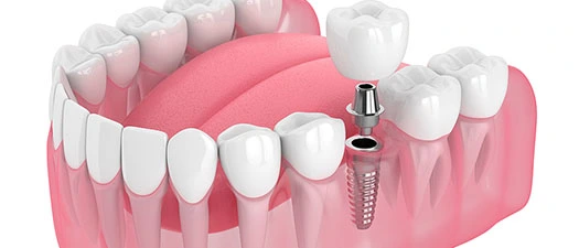 dental implant guildford