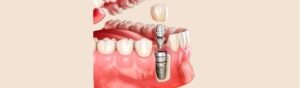 Dental implant