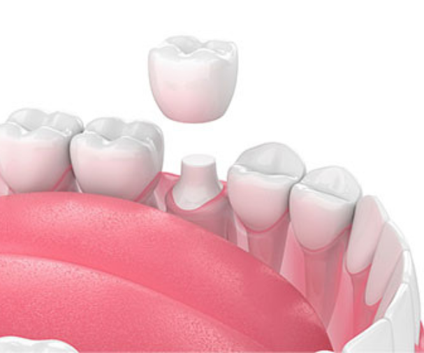 Dental Crown