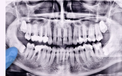 Wisdom Teeth Removal: What You Need to Know