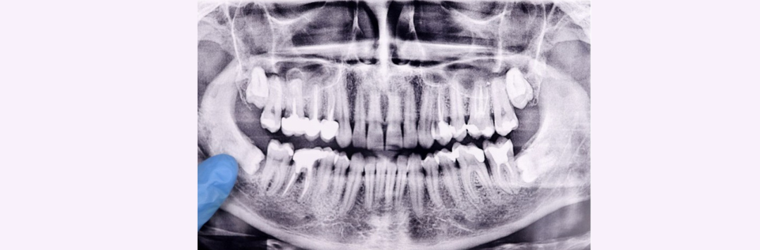 Wisdom Teeth Removal: What You Need to Know