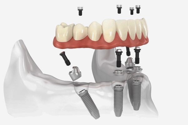 Dental Implants