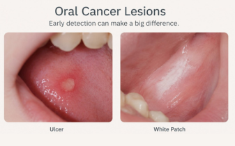 Why an Ulcer or White Patch Should Never Be Ignored