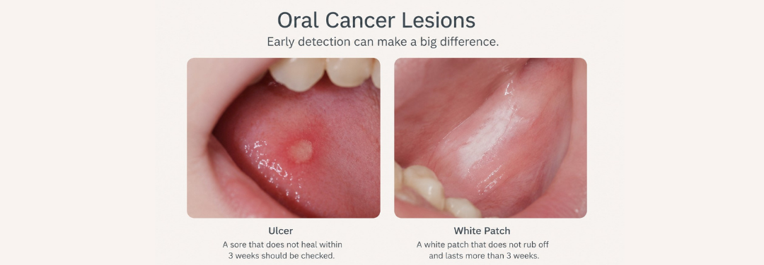 Oral Cancer