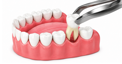 Surrey Wisdom tooth removal (2) Wisdom teeth removal in Surrey