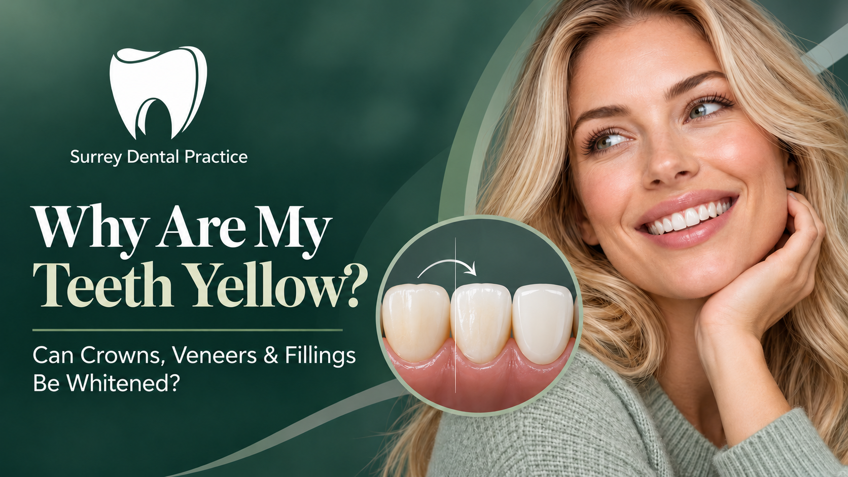 Crowns and Fillings